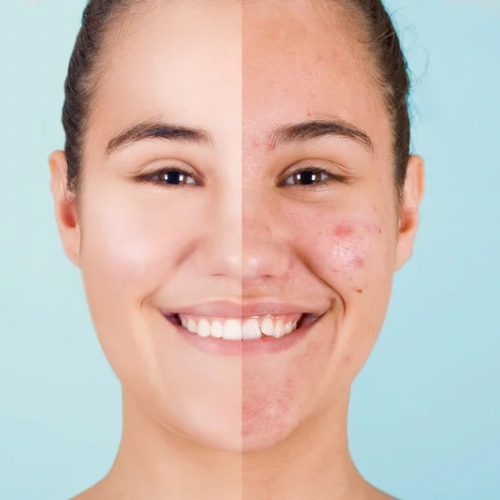 Acne & Oil Control